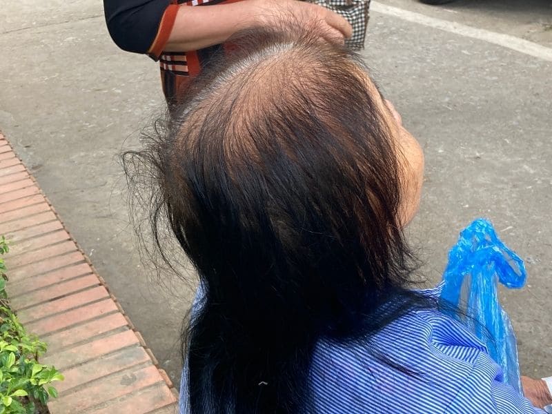 Hair loss on the top of a patient’s head 