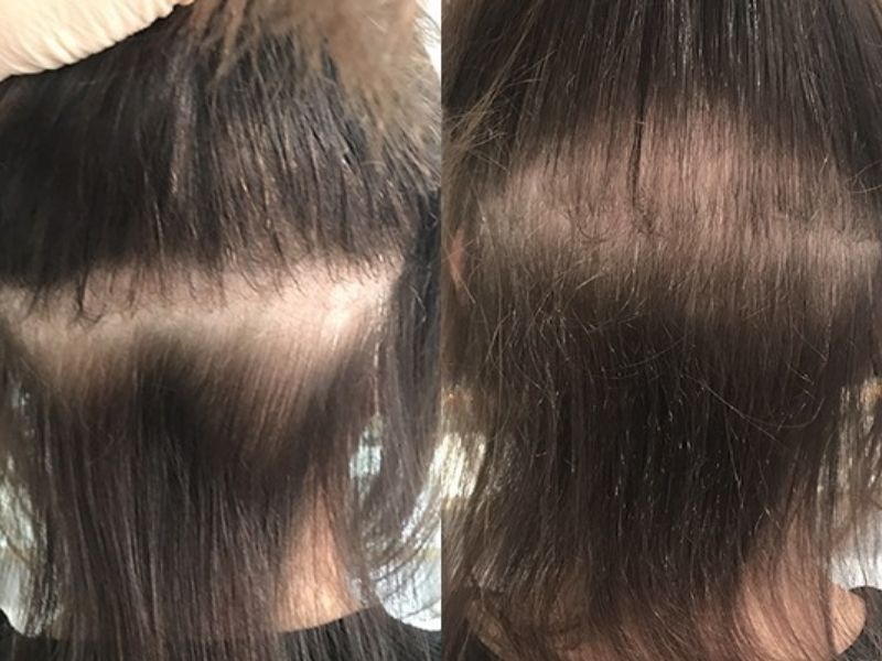 Hair loss due to clip-in hair extension overuse