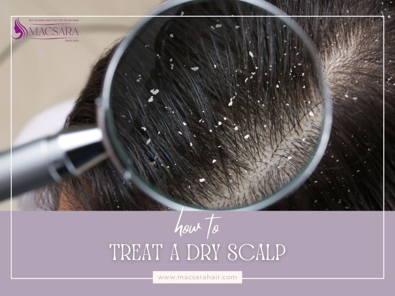 Treatments For Dry Scalp You Should Try Today