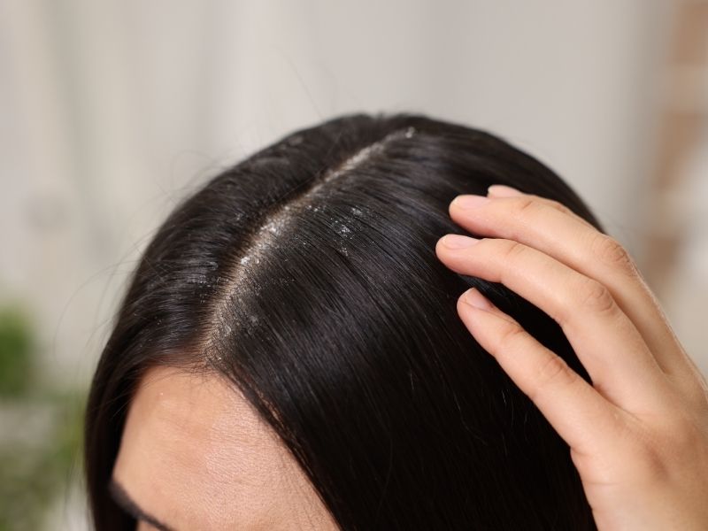 What causes a dry scalp?