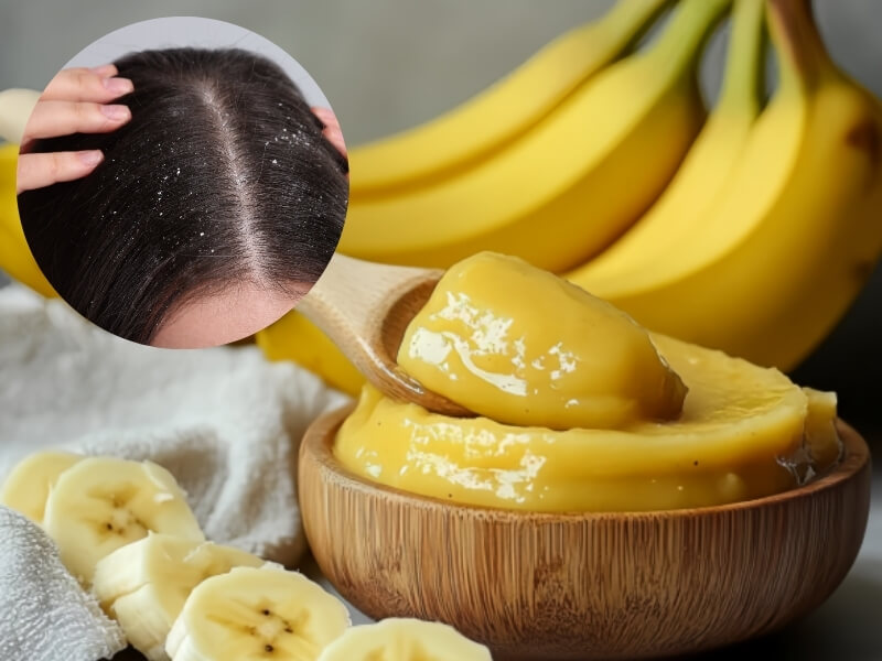 Bananas also provide a remedy for dandruff